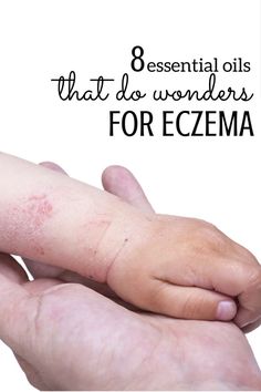 Find out which essential oils you should use for eczema