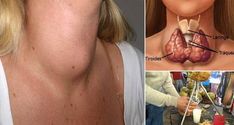 Doctors Will Never Tell You This Here???s How To Cure Your Thyroid Gland With Just One Ingredient!