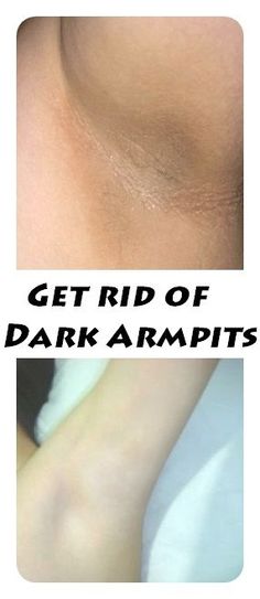 Get rid of dark armpits with our natural / organic method! There is no need for???