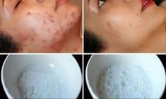This Face Mask Magically Removes Stains, Acne Scars And Wrinkles After Second Use