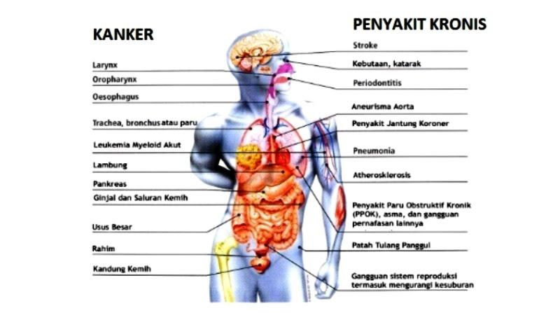 15 Penyakit Akibat Rokok 7344