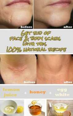 Get rid of face and body scars with this 100% natural recipe: